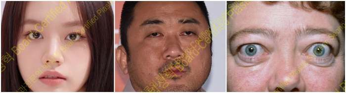 정상눈-안검하수눈