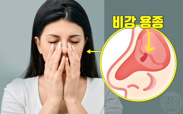 콧물 목 뒤로 넘어가요 후비루 원인 비강용종