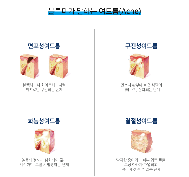 대구여드름 피부과 전문의의 올바른 관리