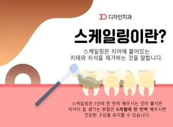 스케일링 후 양치 통증 음식_17