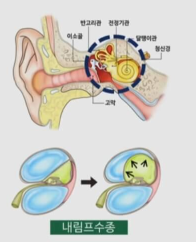  메니에르병 증상 4가지 및 원인 3가지