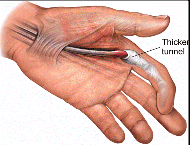  윽! 손가락에서 소리가?...방아쇠 손가락은 당뇨병 징후?..예방법 VIDEO: Hands of People With Diabetes More Often Affected by Trigger Finger
