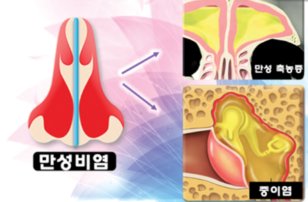  알레르기비염 검사란?