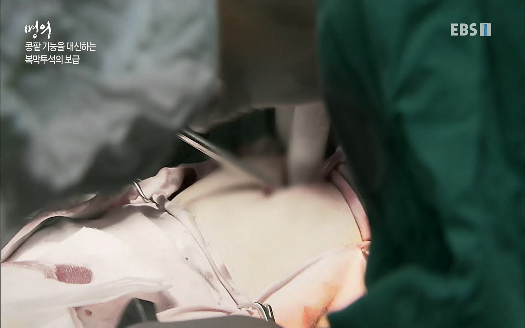 EBS 명의 헬스케어 - TV - 교육의 중심 EBS명의 15년 - 만성 콩팥병 치료, 어디까지 왔나- .mp4_20220802_205715.032.jpg