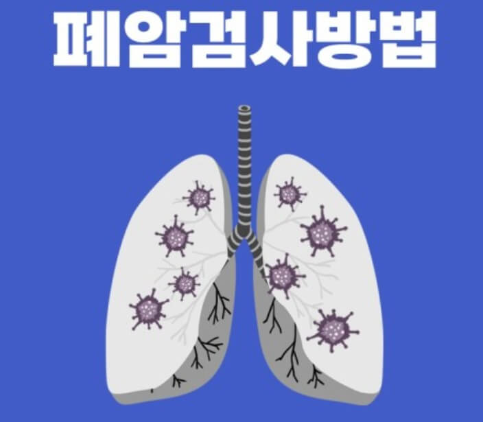 폐암 검사방법과 잔기침, 명의