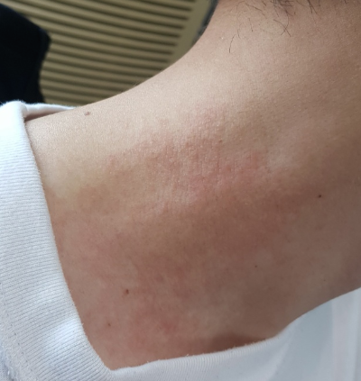  피부 알레르기 악화