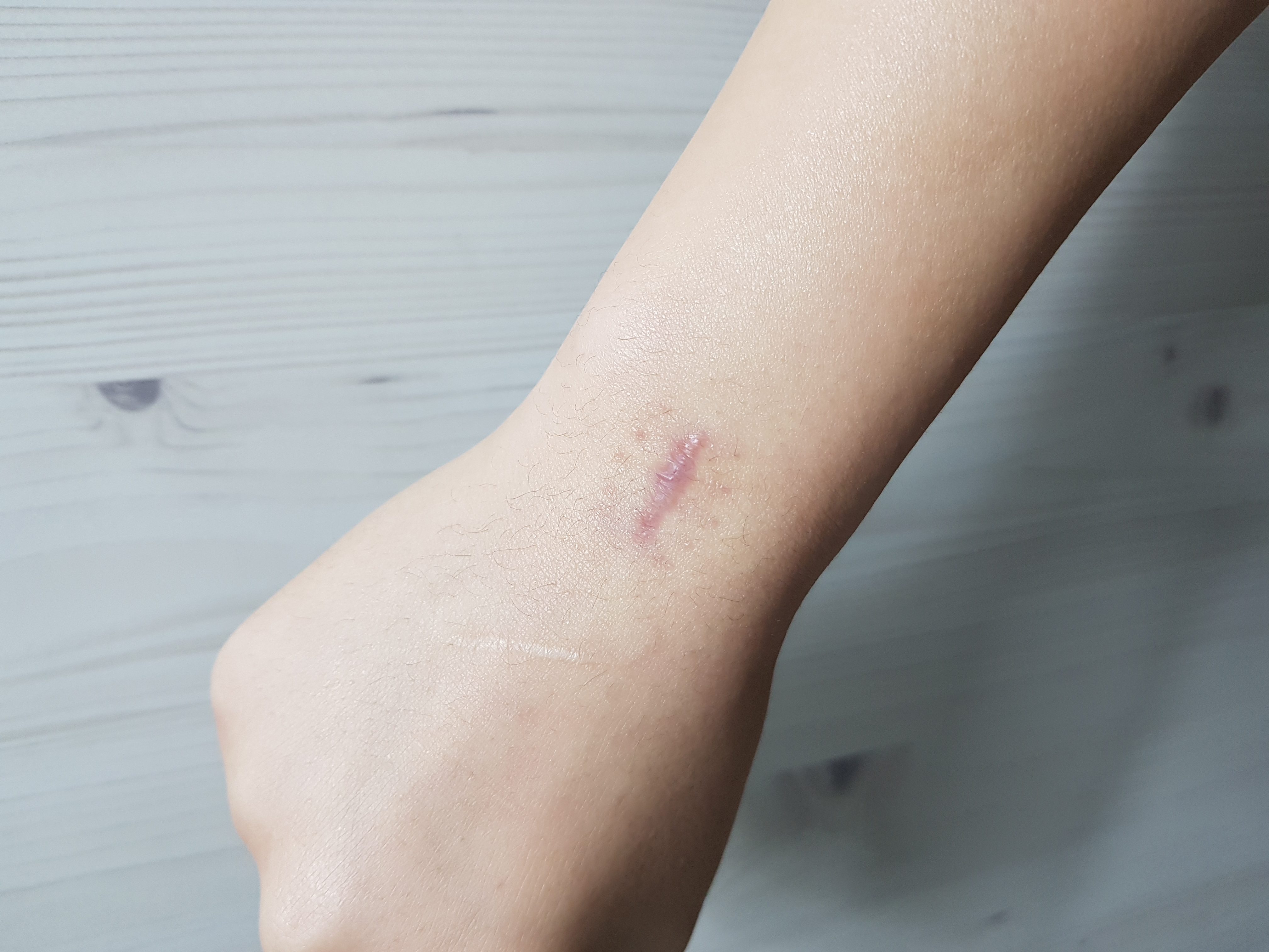 손목결절종 수술 대신 손목보호대로 나은 후기 9