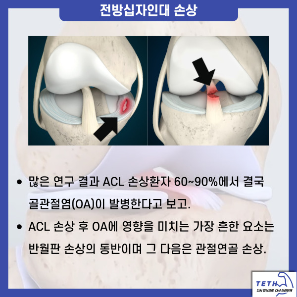 전방십자인대(6)