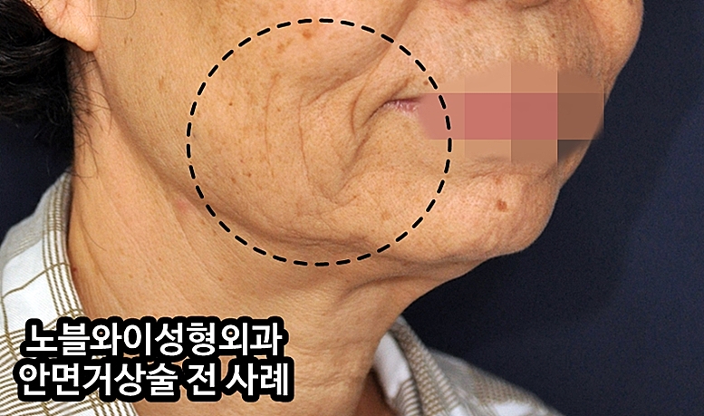  안면거상술유지기간 사실을 말하자면