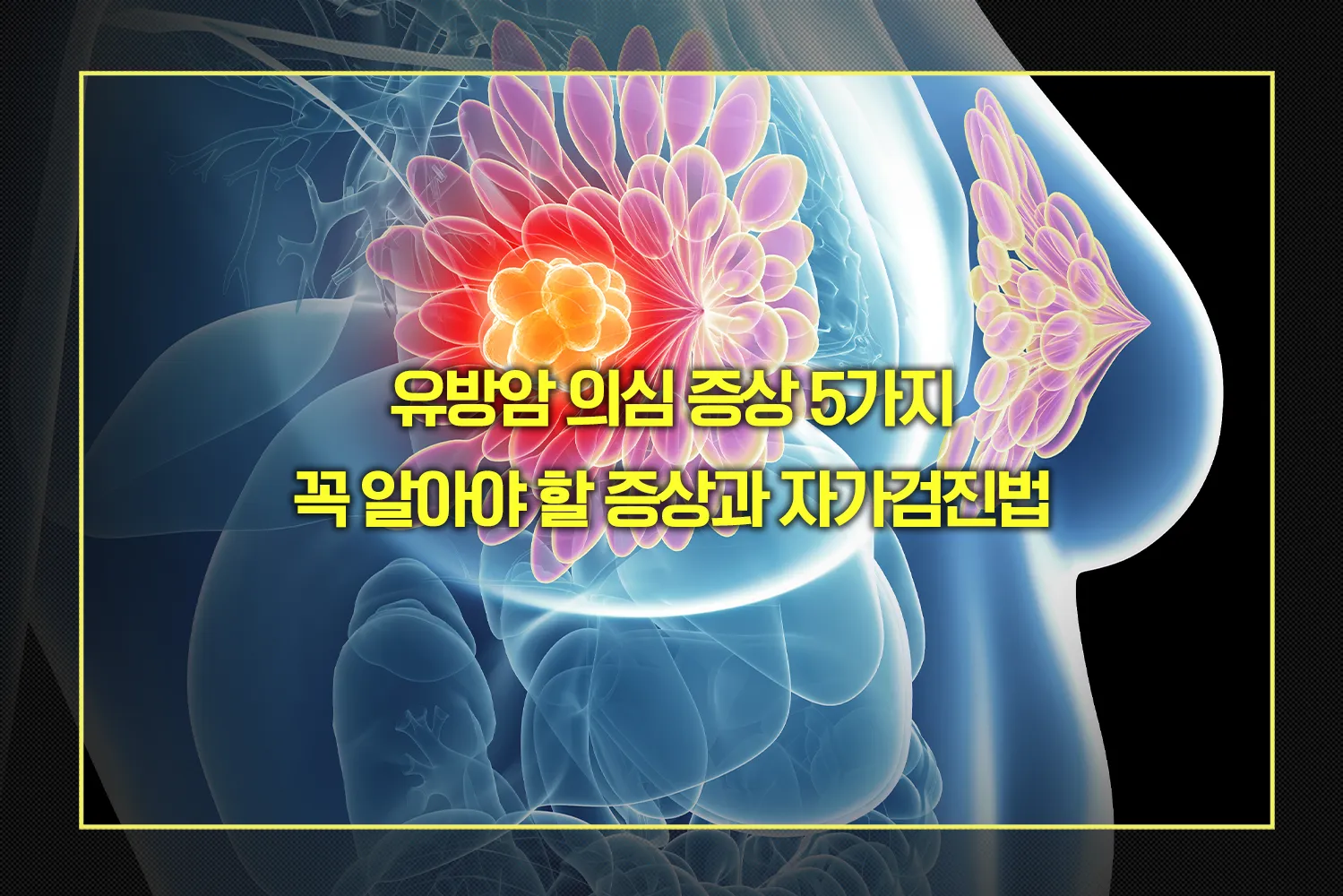 유방암 의심 증상과 자가검진법