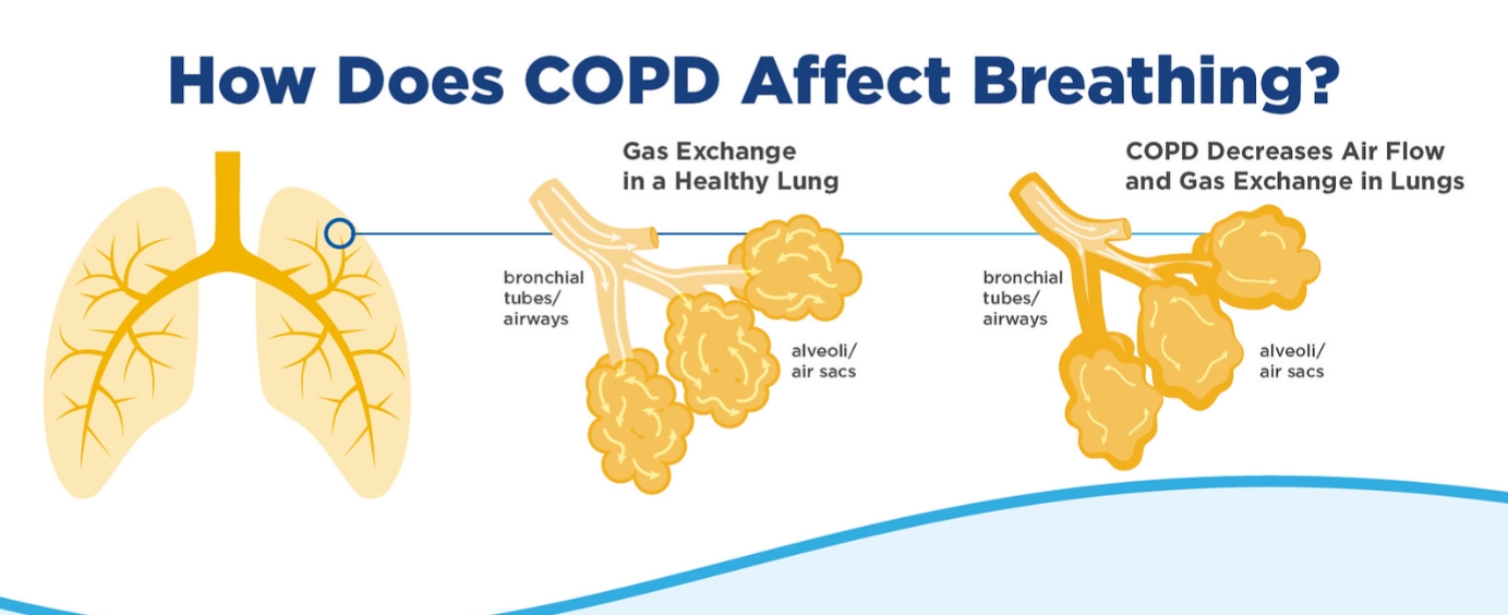 만성 폐쇄성 폐질환(COPD) 진단: 알아야 할 사항