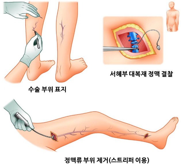 하지정맥류, 방치하면 큰일 난다! 조기 진단의 중요성2