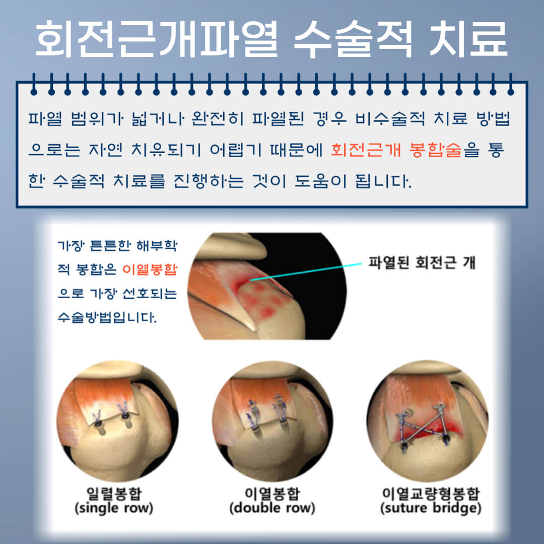 회전근개파열 수술적치료