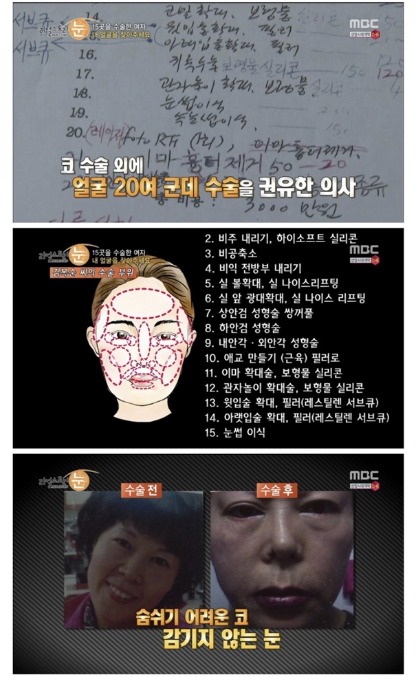 성형수술 피해