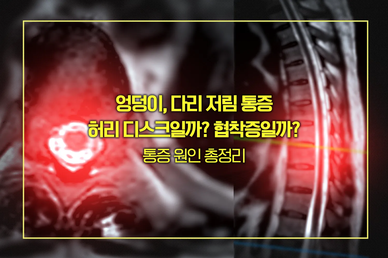 엉덩이다리저림-허리디스크-협착증-원인