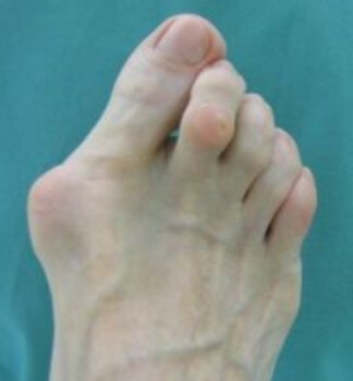무지외반증 환자 발 모양