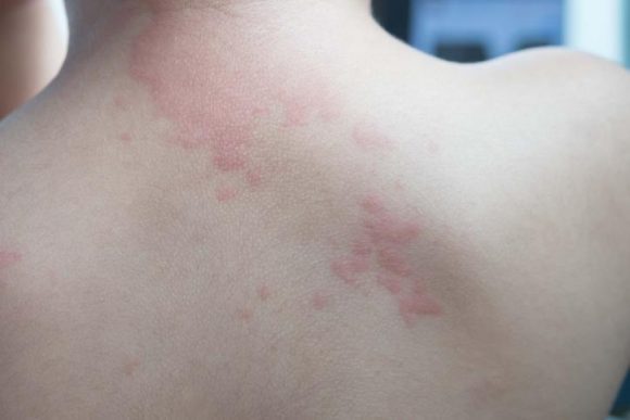 대상포진 예방접종