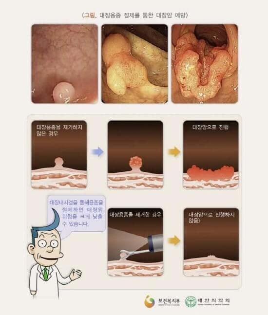  용종 제거후 식사 커피 음주 흡연 언제부터? 용종 선종이란?