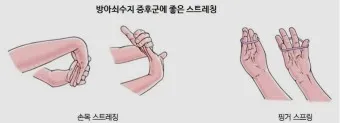 방아쇠수지증후군 엄지손가락 통증 치료법_10