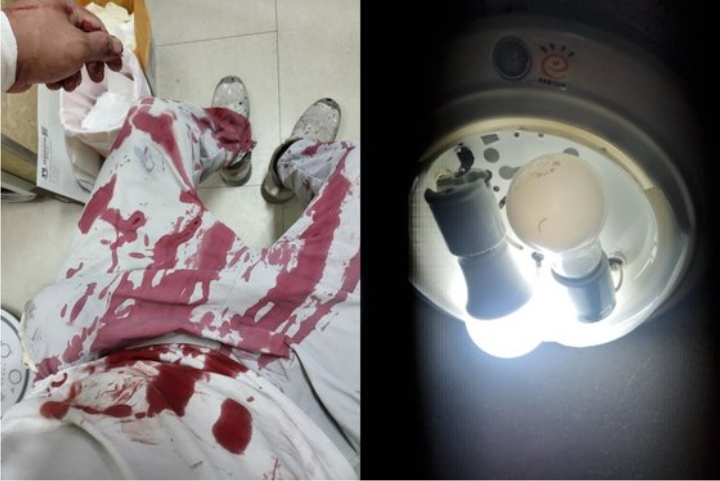 김포 아파트 천장서 떨어진 조명에 맞아 피가 분수처럼 터진 작업자