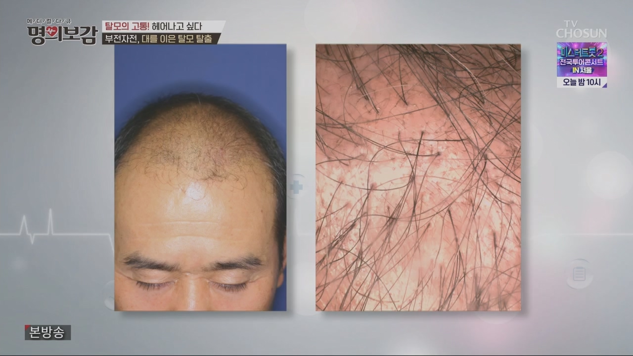 메디컬다큐 명의보감.E03.230527p.H264-F1RST.mp4_20230529_173117.444.jpg