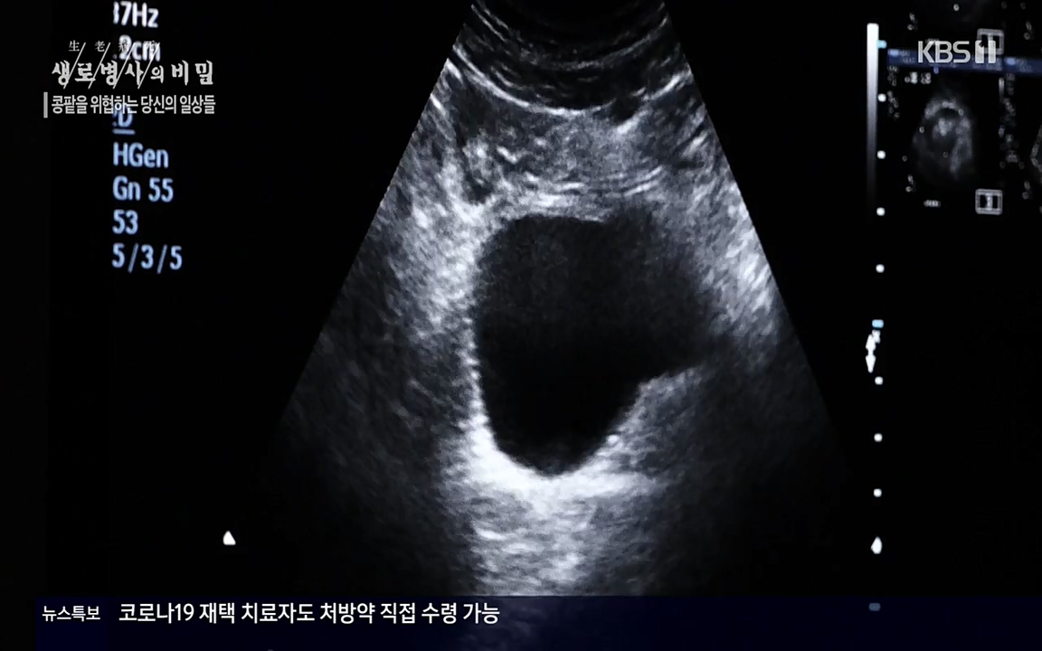 생로병사의 비밀.E819.220421p-NEXT.mp4_20220421_194718.055.jpg