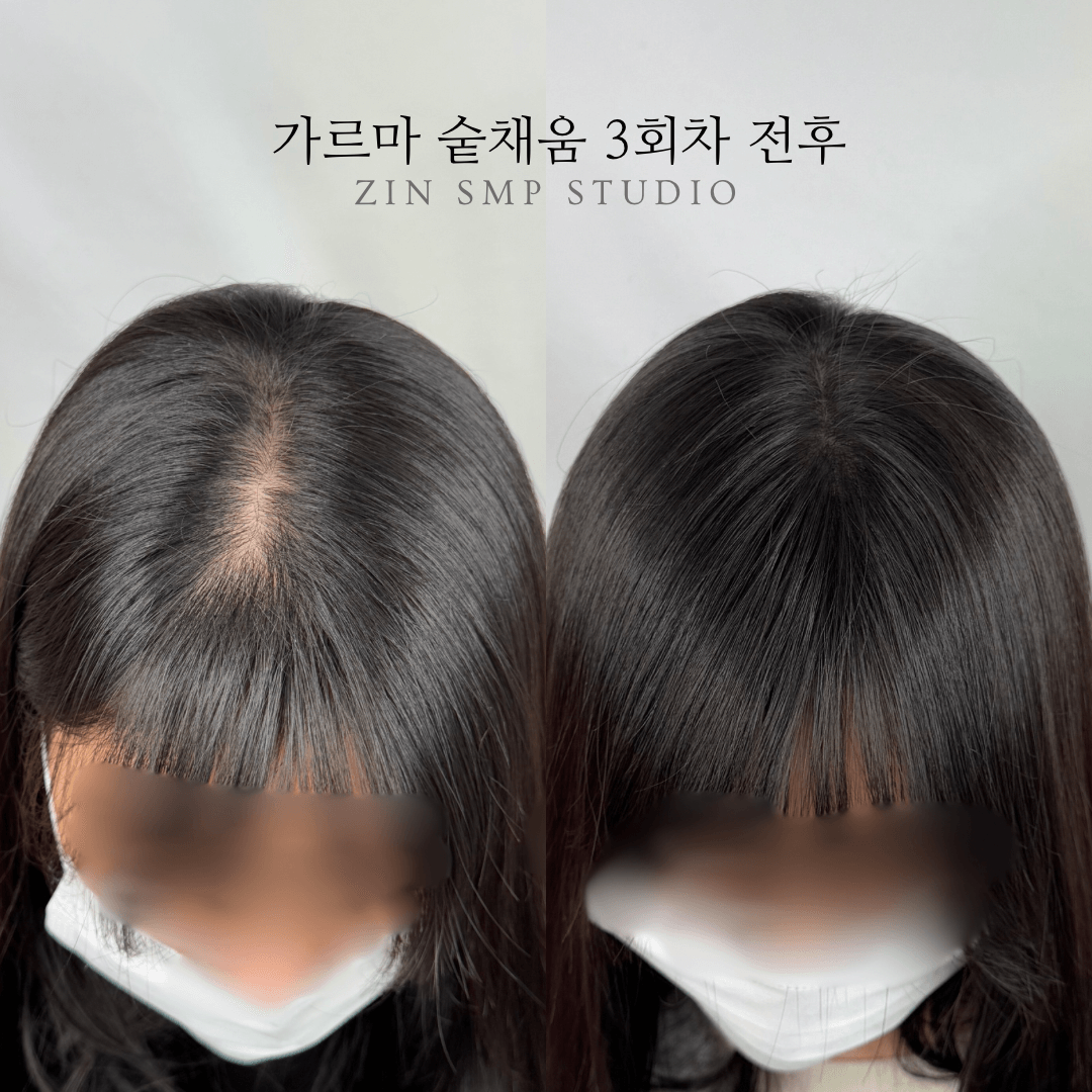 홍대두피문신