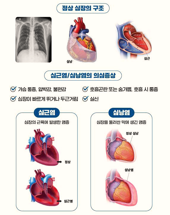  젊은 남성일수록 화이자 접종 후 심근염 발생할 확률이 높다