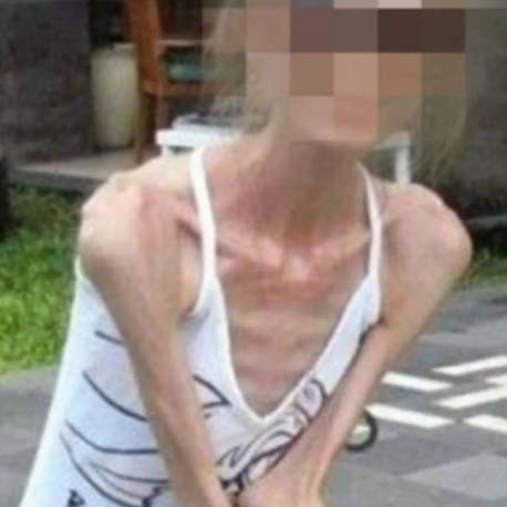  뼈말라 인간이란? 나비약(펜터민, 펜디메트라진) 부작용