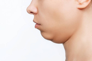 Let's Explore Effective Methods to Get Rid of Sagging Double Chin.