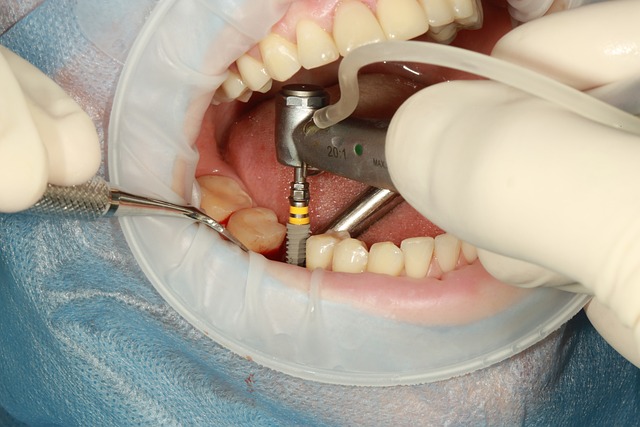 임플란트 시술 받는 치아의 모습