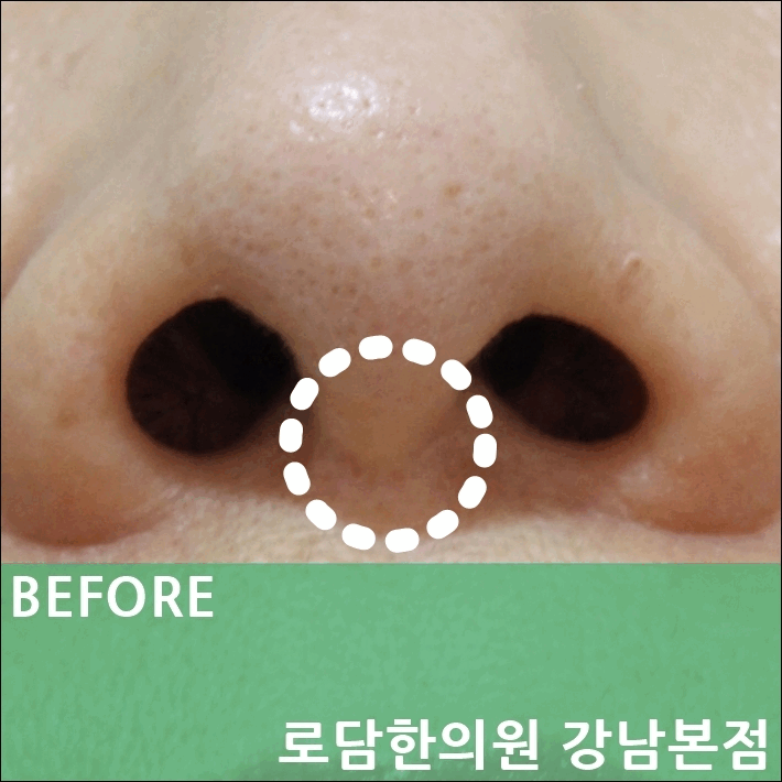  코 성형 흉터 걱정이 된다면 로담한의원 새살침 치료를