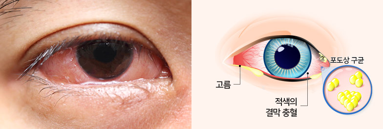  여름철 유행성 결막염 증상과 예방 방법