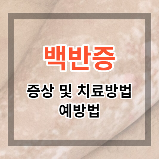  백반증 증상 및 원인, 치료방법과 예방법 알아보기
