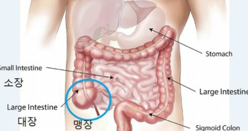  남자&여자 맹장위치 그리고 맹장염 초기증상 4가지