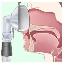 수면무호흡증 원인 및 치료방법