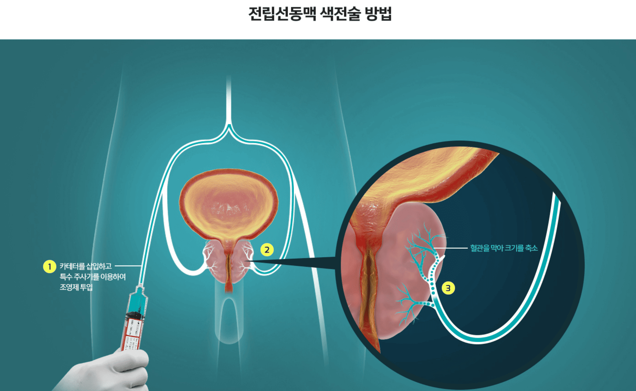 전립선비대증치료 전립선비대증수술비용 비뇨기과남성수술비용