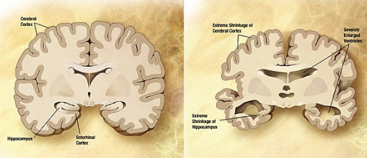 정상인 뇌(왼쪽)와 알츠하이머 환자의 뇌(오른쪽)