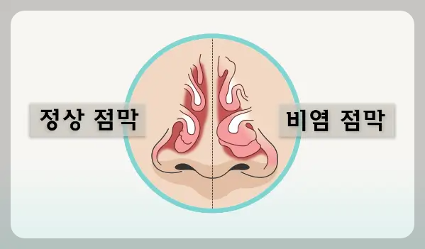 비염