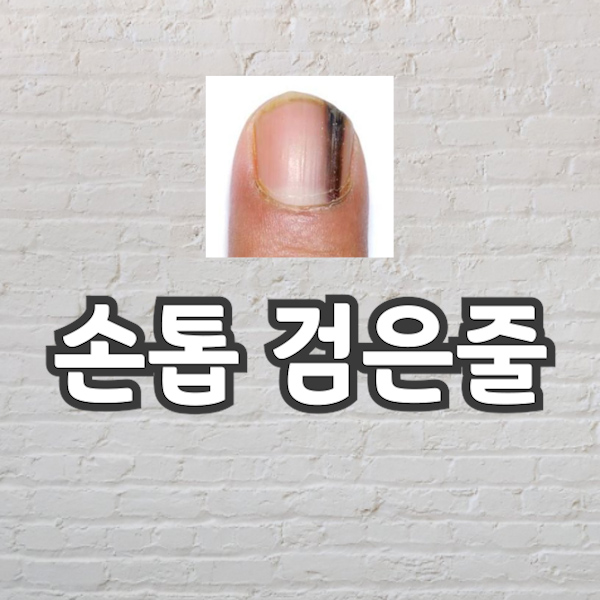 손톱에 검은줄 설명