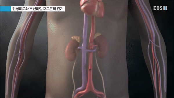  (명의) 만성피로증후군을 아시나요