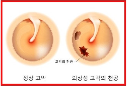  고막 천공 수술 후기 찢어지면 생기는 증상 (치료방법)