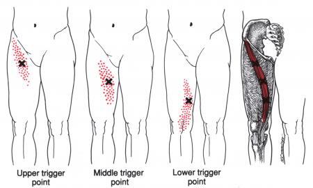 허벅지의 trigger point_봉공근