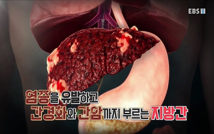 명의_ 제 764회 〈지방간의 경고 1부, 살찐 간이 위험하다〉_ 220429.avi_20220503_193626.463.jpg