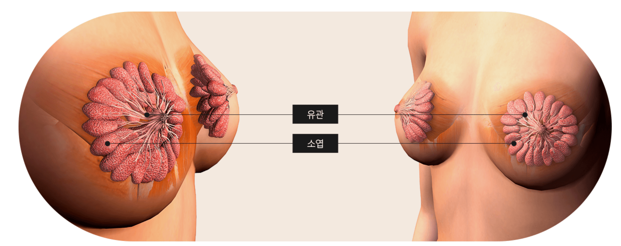 유방암 초기증상 검사비용 유방암 자가진단