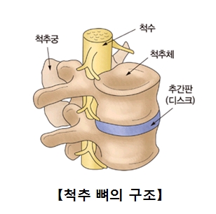 추간판탈출증