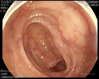 대장내시경 당일식사 주의사항 피해야 하는 음식_14