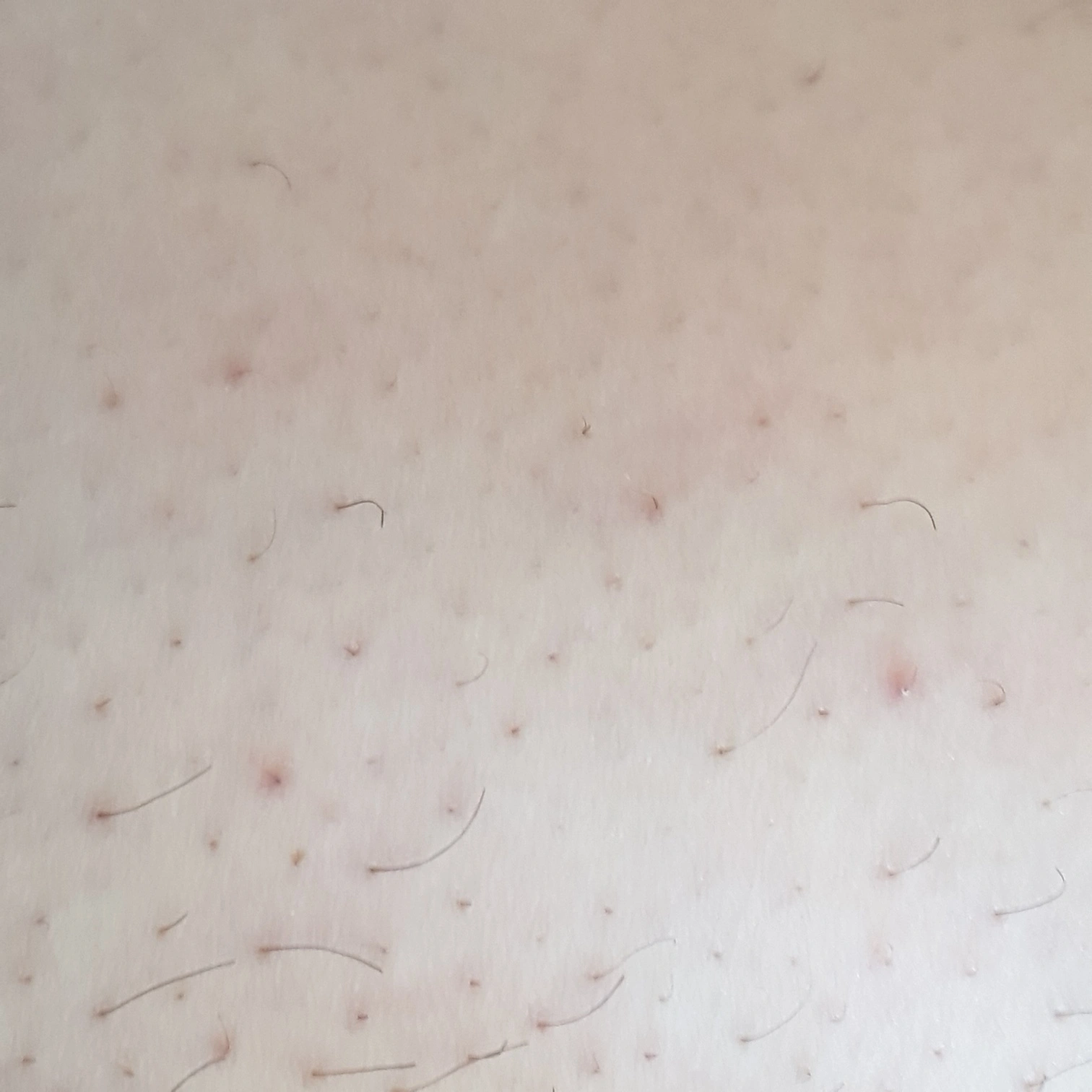  팔, 다리에 생기는 모공각화증 발생하는 원인, 증상 및 치료방법