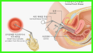 자궁 경부암 원인 증상 치료 및 예후 재발과 사망률