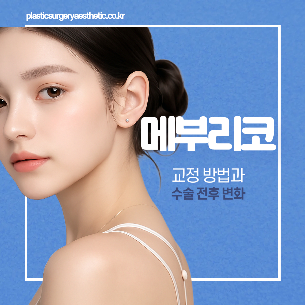 매부리코 교정 방법과 수술 전후 변화